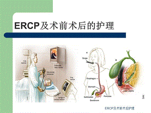 最新ERCP及术前术后护理.ppt