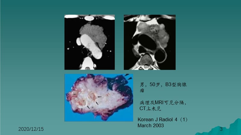 胸腺肿瘤影像诊断（干货分享）.ppt_第3页