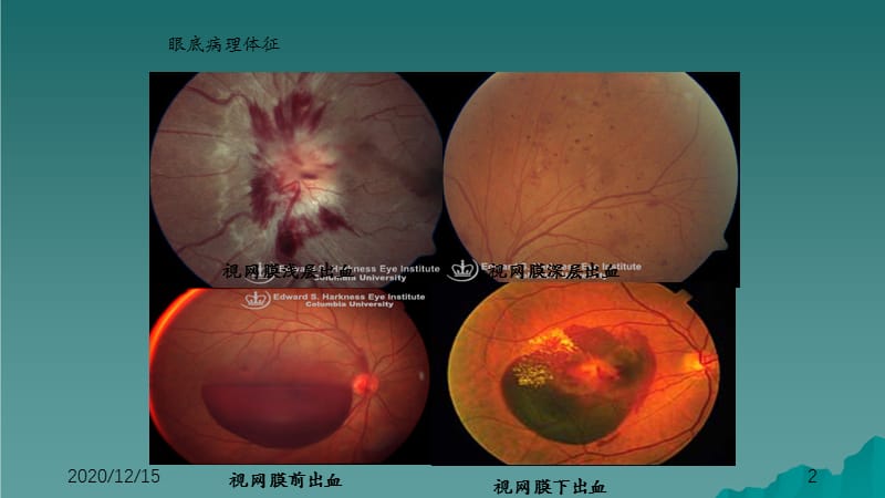 视网膜血管疾病（干货分享）.ppt_第2页