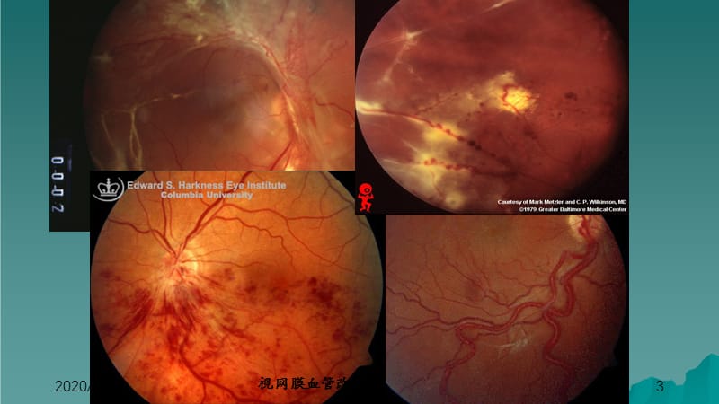 视网膜血管疾病（干货分享）.ppt_第3页