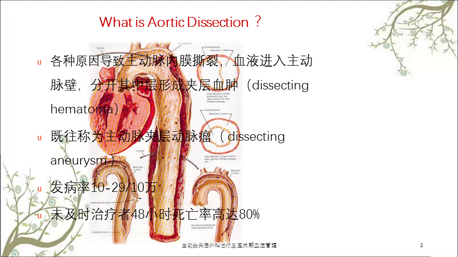 主动脉夹层外科治疗及围术期血压管理课件.ppt_第2页