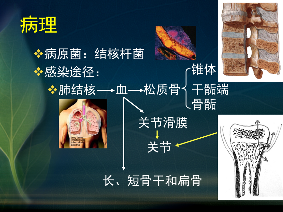 5_骨关节结核.ppt_第1页