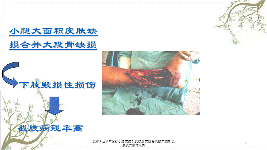 皮瓣骨运输术治疗小腿大面积皮肤及大段骨缺损大面积皮肤及大段骨缺损课件.ppt_第2页