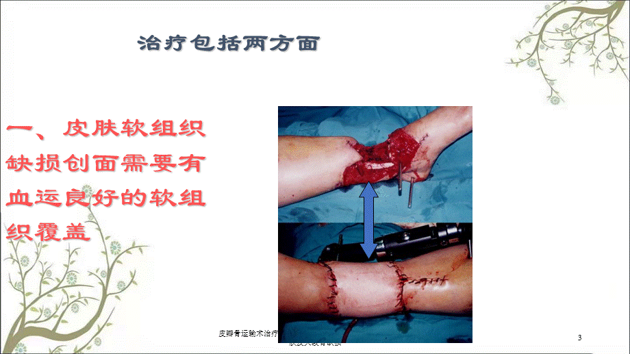 皮瓣骨运输术治疗小腿大面积皮肤及大段骨缺损大面积皮肤及大段骨缺损课件.ppt_第3页