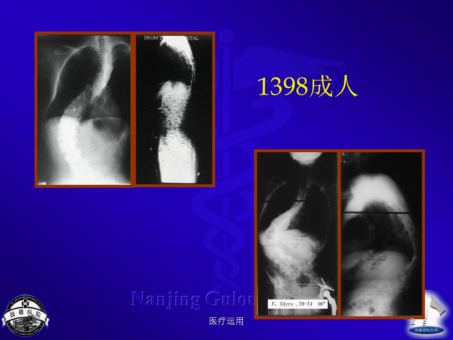 成人脊柱侧凸的的治疗南京大学医学院附属鼓楼医院脊柱外科[医疗经验].ppt_第2页