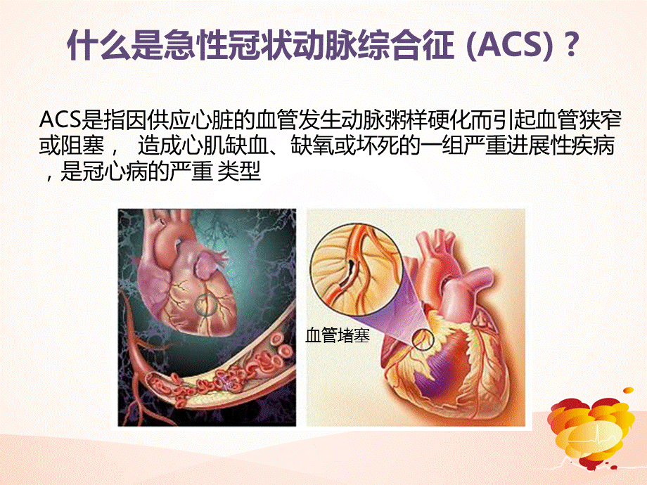 ACS患者治疗策略.ppt_第2页