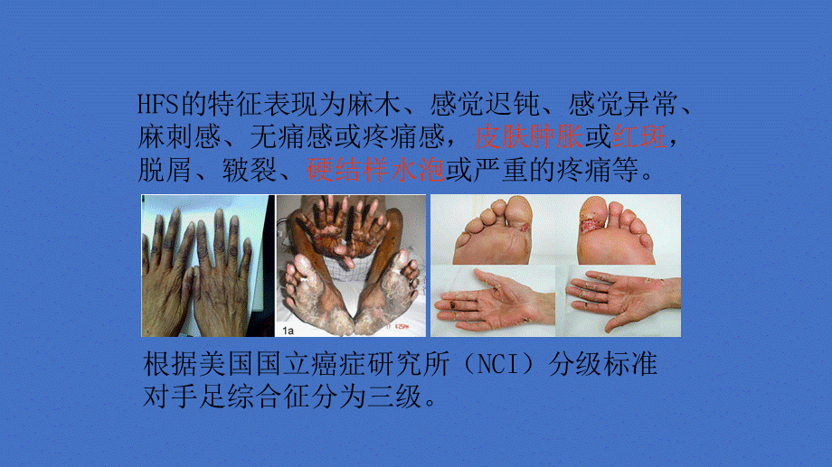 手足综合征(1).ppt_第3页