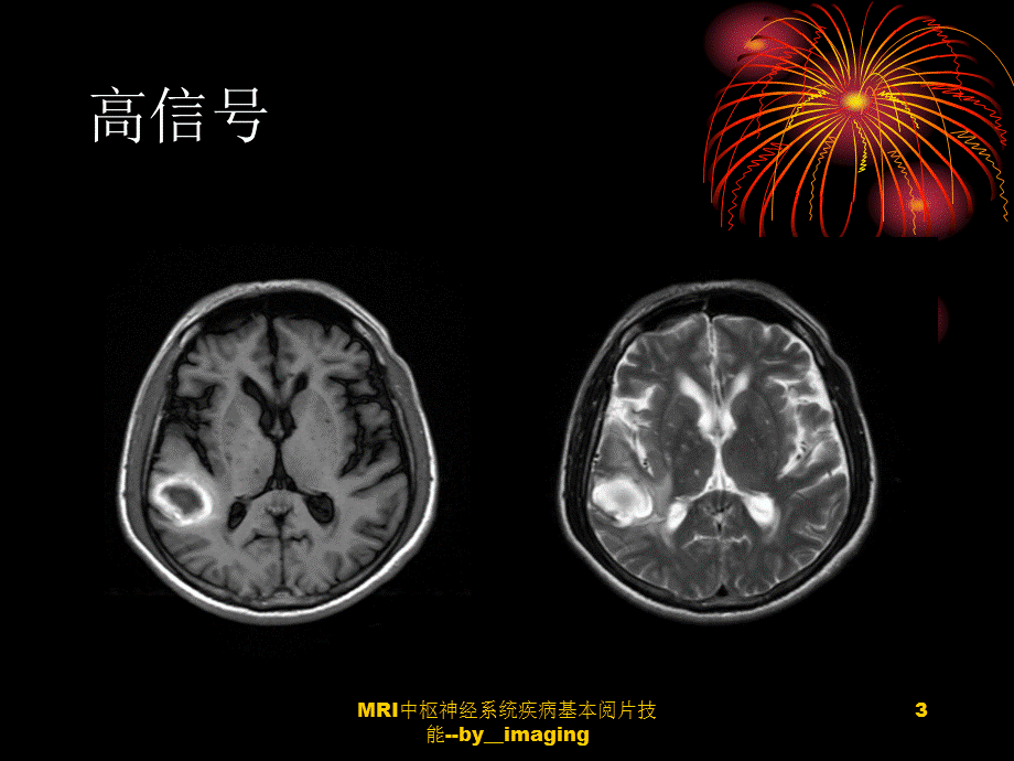 MRI中枢神经系统疾病基本阅片技能--by__imaging课件.ppt_第3页