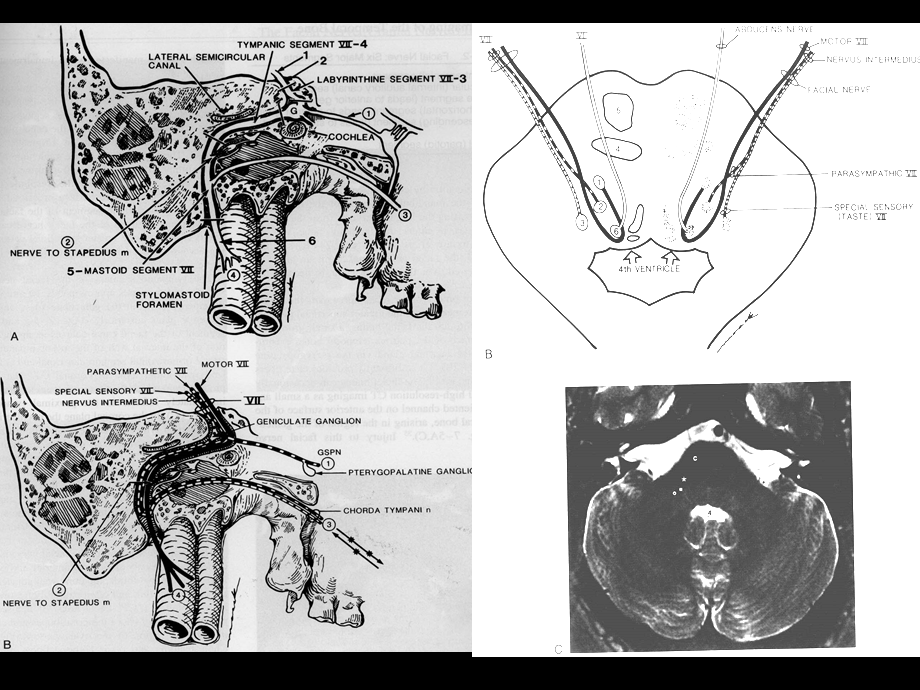 面神经的影像学诊断PPT课件.ppt_第3页