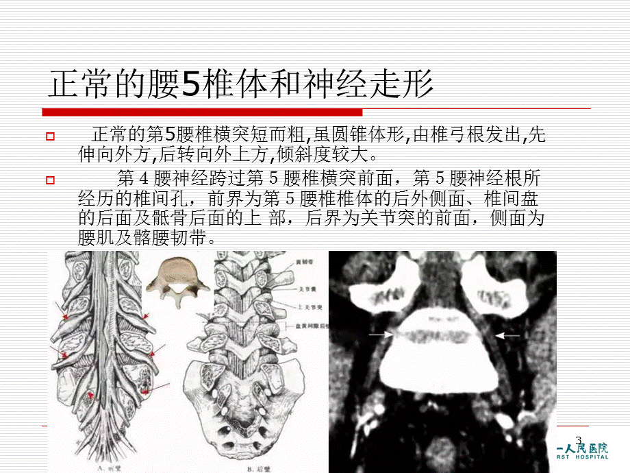 腰椎横突肥大综合征.ppt_第3页