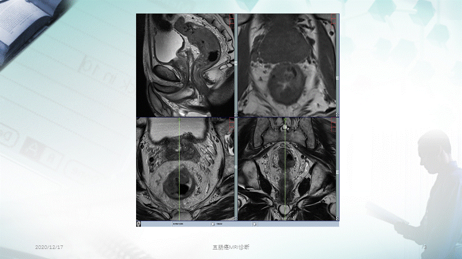 直肠癌MRI诊断（精选PPT干货).pptx_第3页