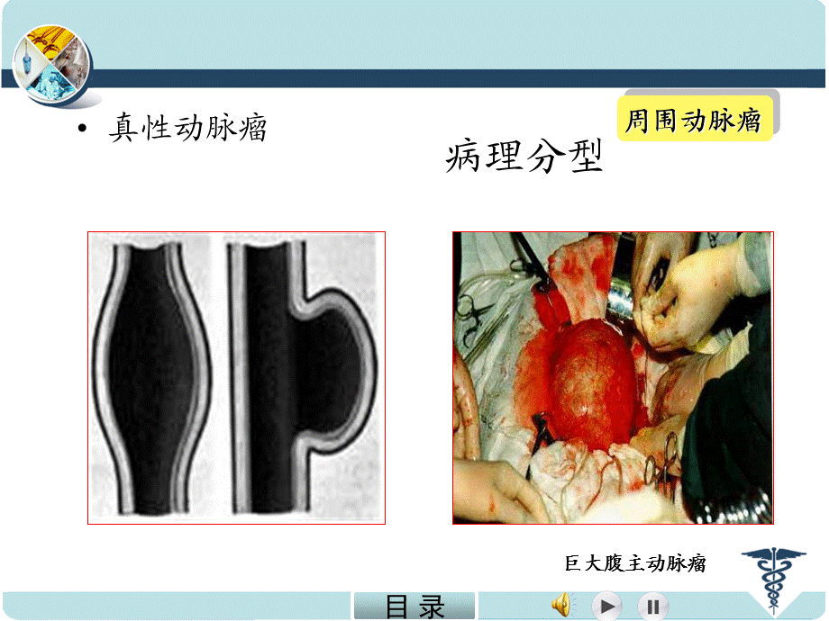 动脉瘤 中国医科大学附属第一医院 .ppt_第3页