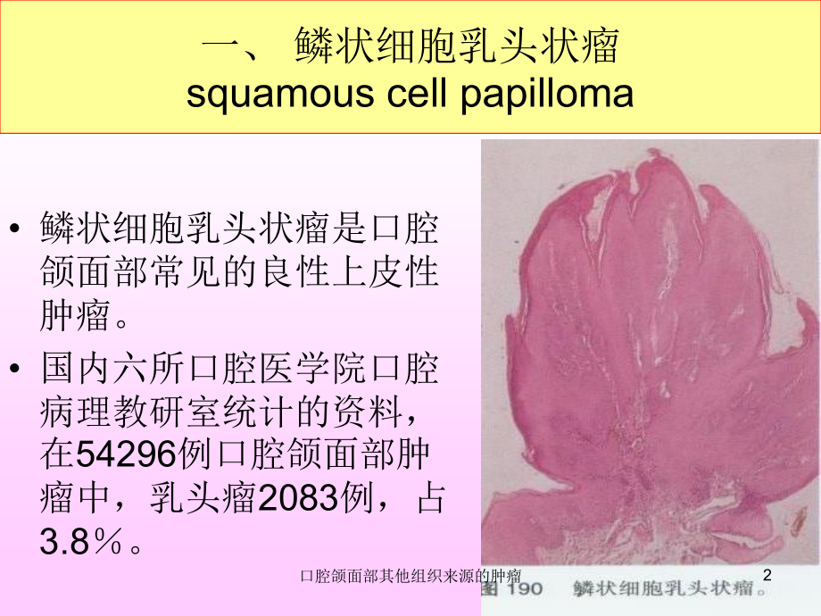 口腔颌面部其他组织来源的肿瘤课件.ppt_第2页