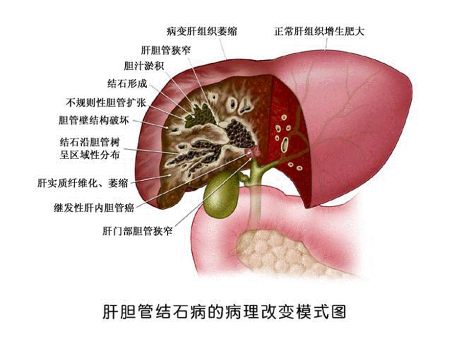 肝胆管结石病诊断治疗指南课件.ppt_第3页