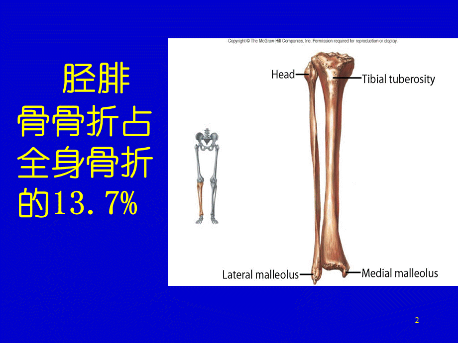 《骨外科胫腓骨骨折》.ppt_第2页