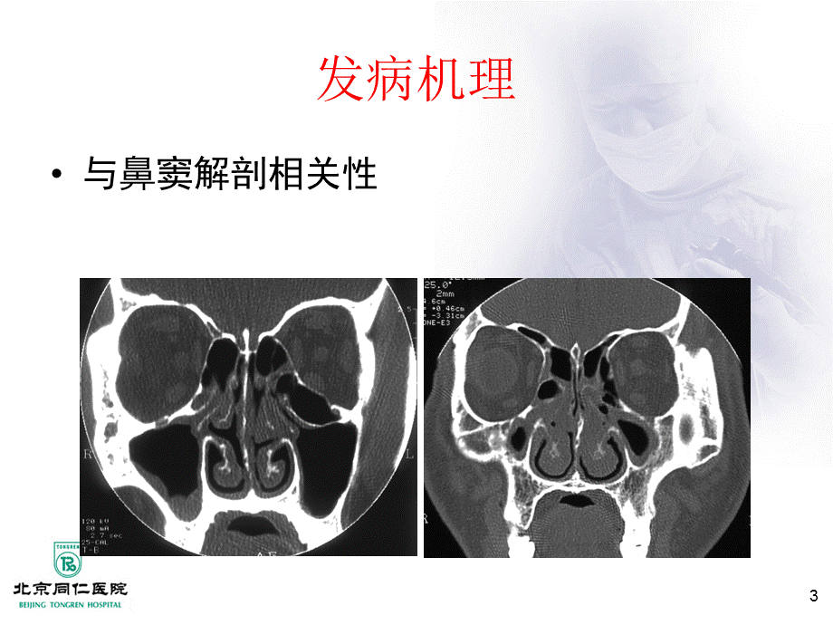 《鼻窦炎及并发症》.ppt_第3页