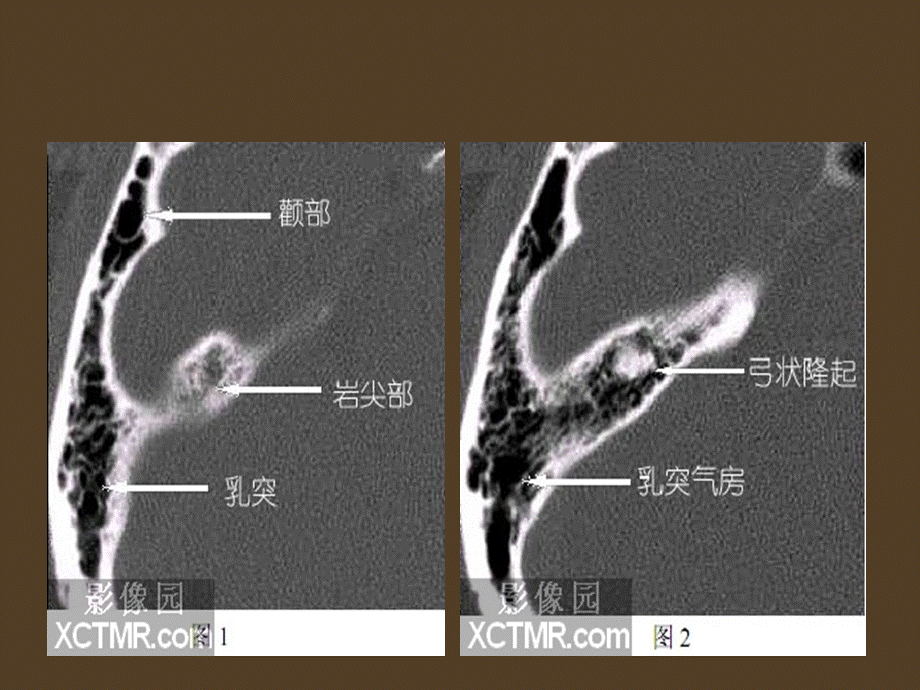 《耳部解剖影像解剖》.ppt_第2页