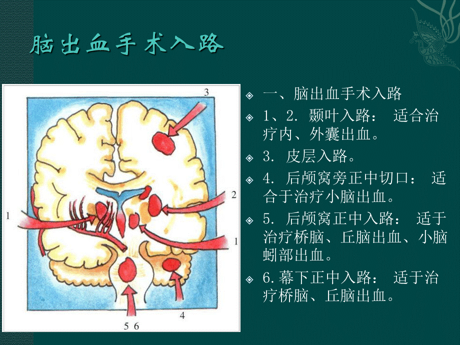 《神经外科手术入路》.ppt_第1页