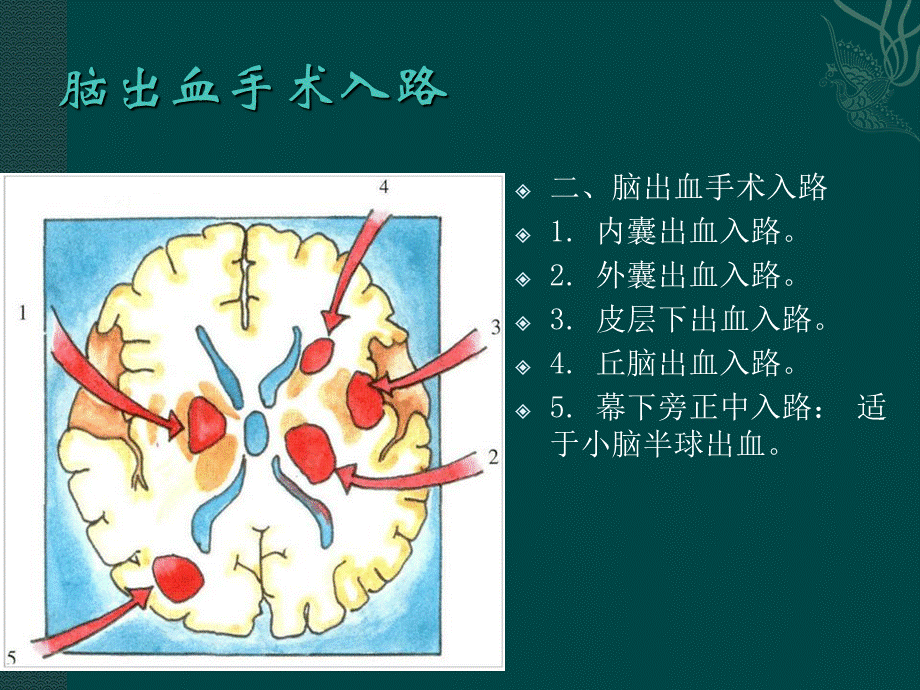 《神经外科手术入路》.ppt_第2页