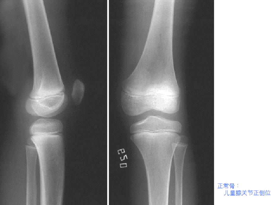 骨与关节基本病理表现课件.ppt_第3页