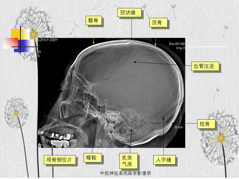 中枢神经系统医学影像学.ppt_第3页