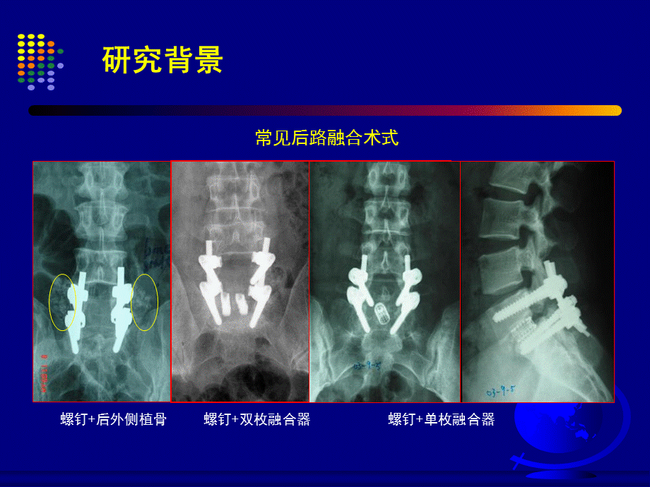 67腰椎滑脱后路不同融合术式的有限元研究上海长海医院赵杰.ppt_第2页