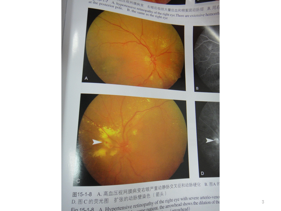 高血压眼底改变课件.ppt_第3页