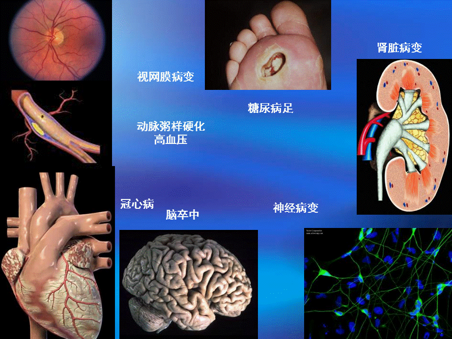 糖尿病与足保护课件.ppt_第3页