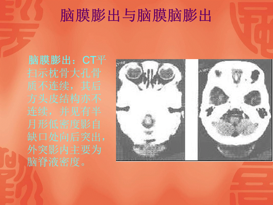 颅脑先天性疾病.ppt_第3页