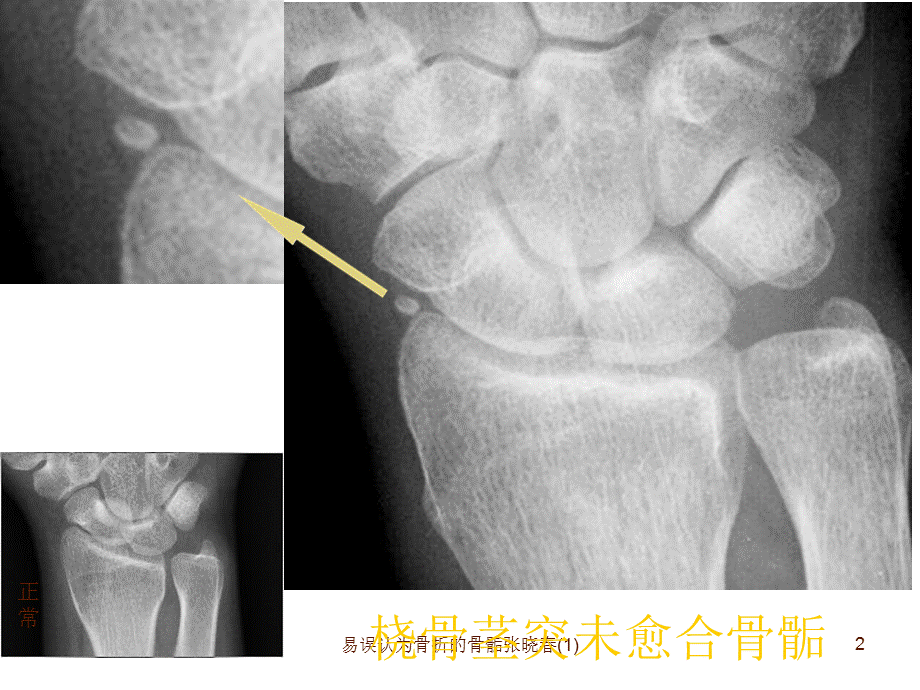 易误认为骨折的骨骺张晓春(1)课件.ppt_第2页