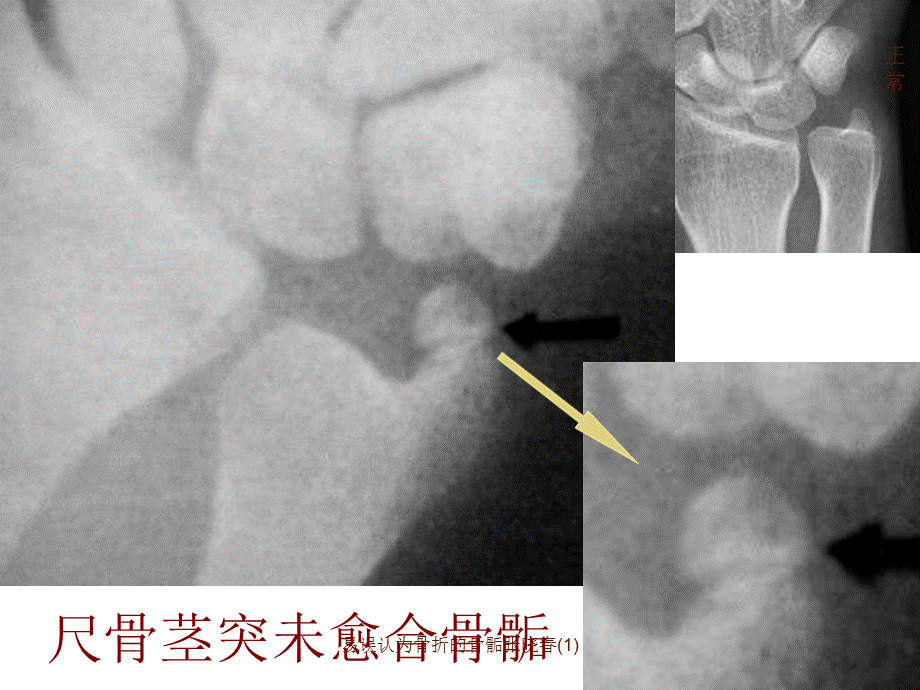 易误认为骨折的骨骺张晓春(1)课件.ppt_第3页