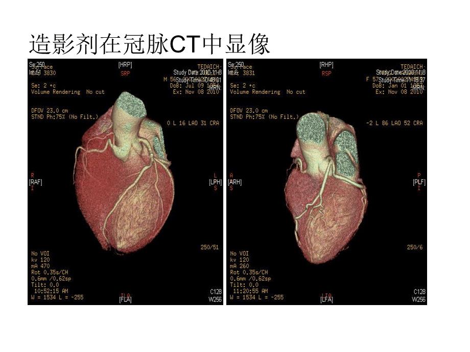 造影剂肾病-完美版.ppt_第2页