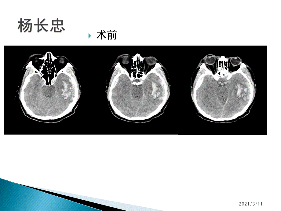 颅脑损伤开颅去骨瓣减压术的规范化应用.pptx_第2页