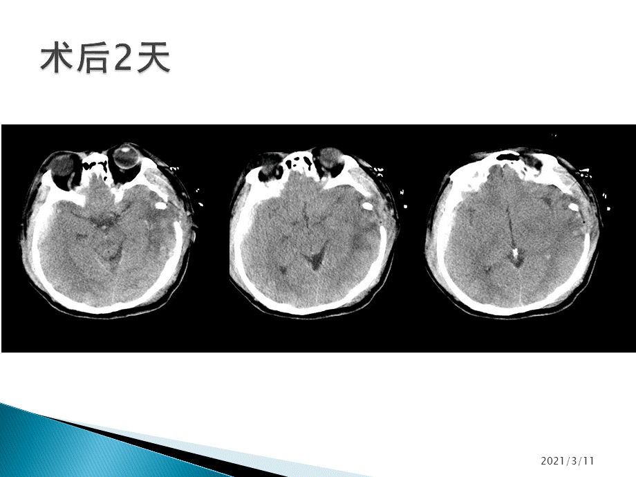 颅脑损伤开颅去骨瓣减压术的规范化应用.pptx_第3页