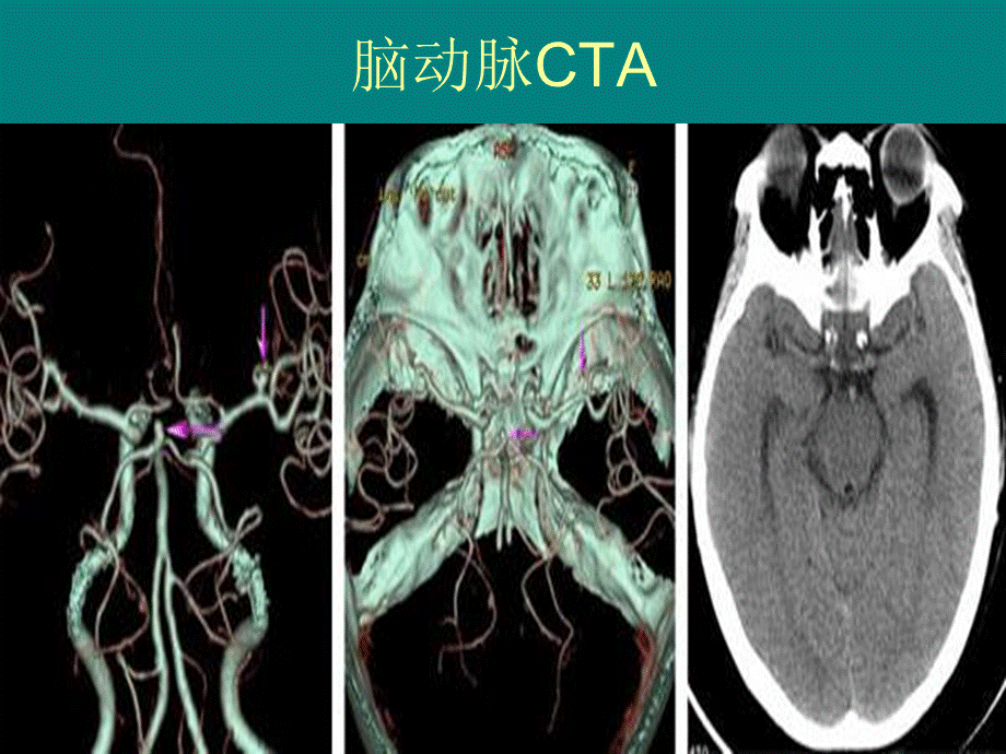 多排螺旋CT的临床应用课件.ppt_第3页