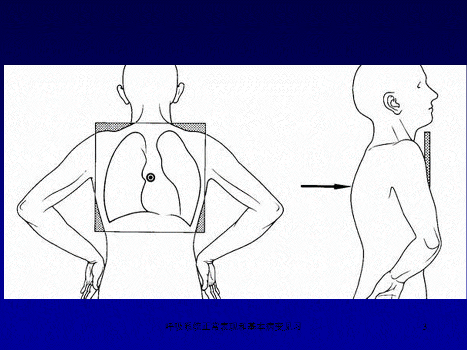 呼吸系统正常表现和基本病变见习课件.ppt_第3页