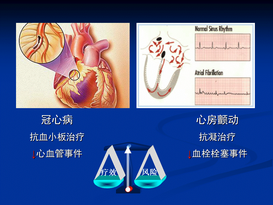 冠心病合并心房颤动患者抗栓治疗方案策略.ppt_第2页