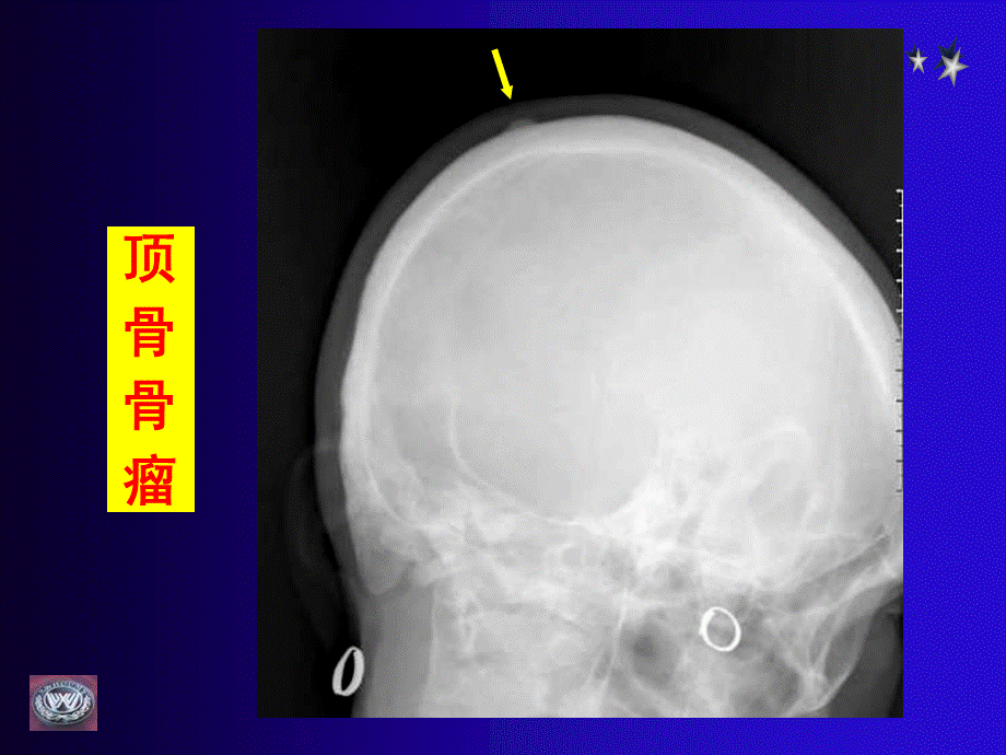 骨肿瘤CT和MRI的影像表现.ppt_第3页