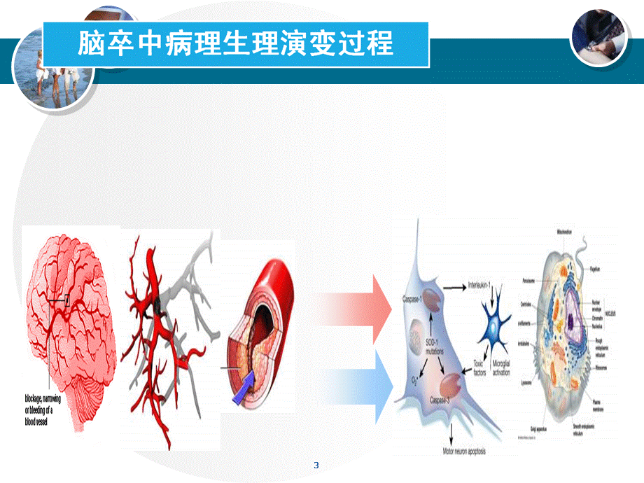 急性脑梗塞的病理生理与治疗策略课件.ppt_第3页