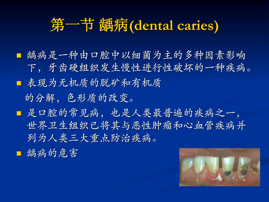 口腔医学牙体牙髓病牙列缺损和缺掉课件.ppt_第2页