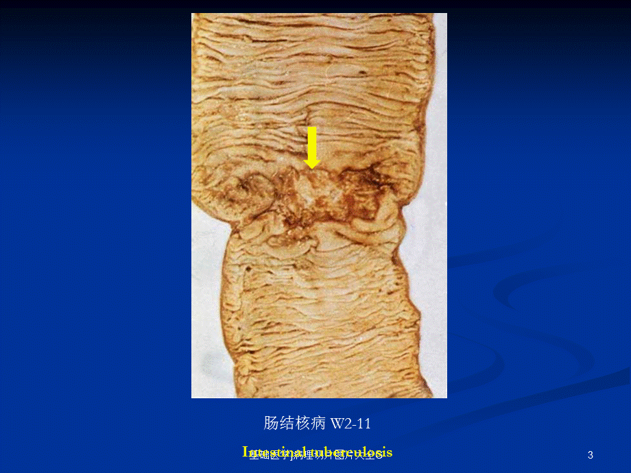 基础医学病理切片图片大全G课件.ppt_第3页