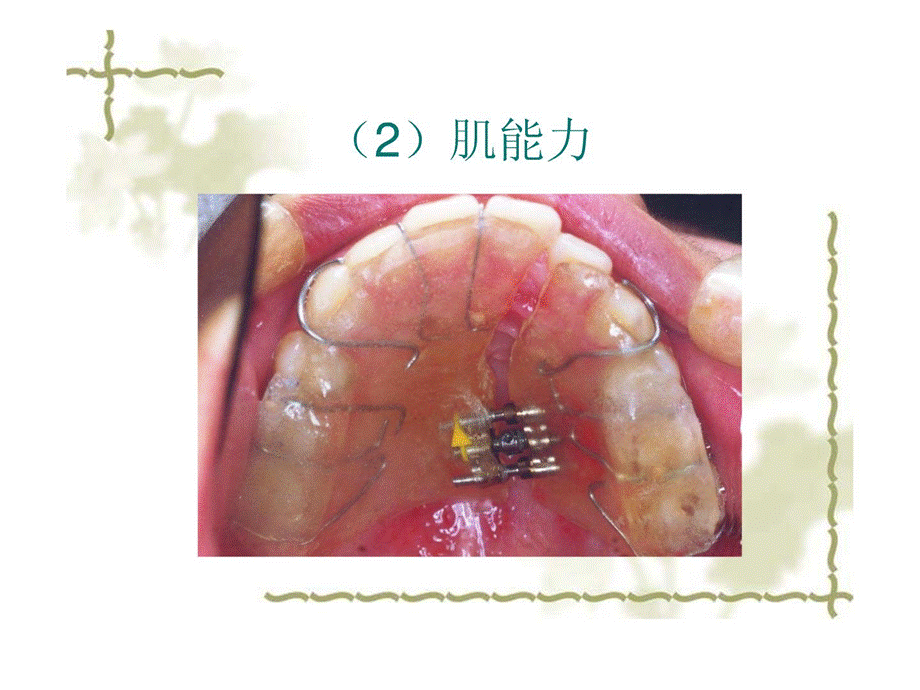 口腔正畸学正畸治疗的生物机械道理课件.ppt_第3页