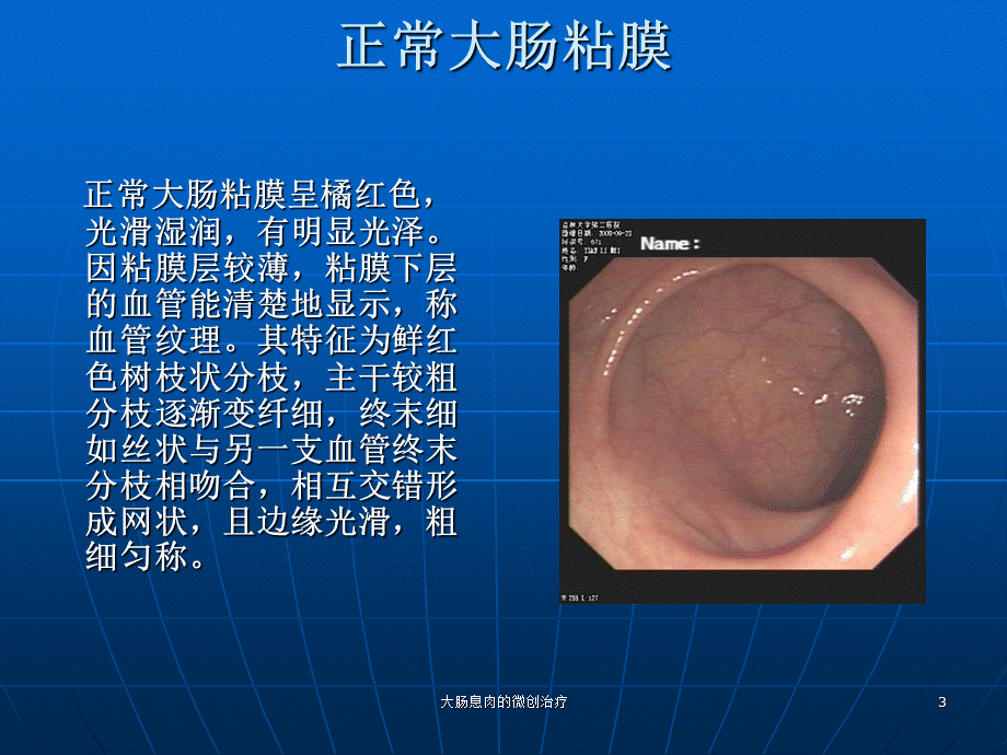 大肠息肉的微创治疗课件.ppt_第3页