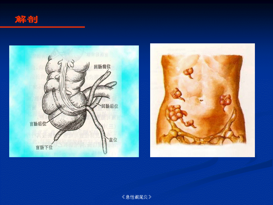 《急性阑尾炎》课件.ppt_第2页