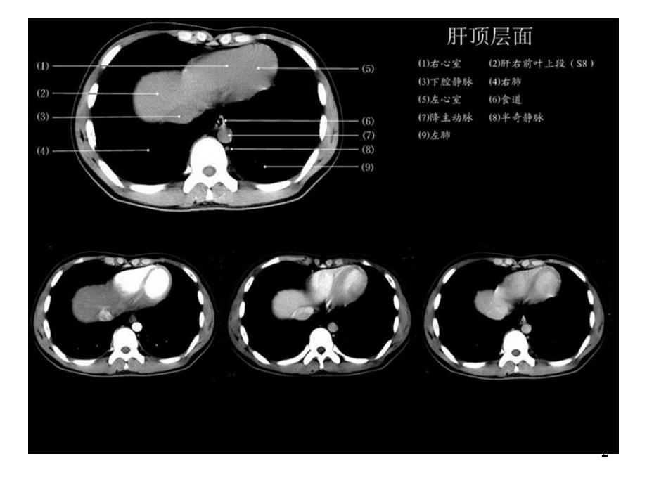 《正常肝脏CT解剖》演示PPT.ppt_第2页