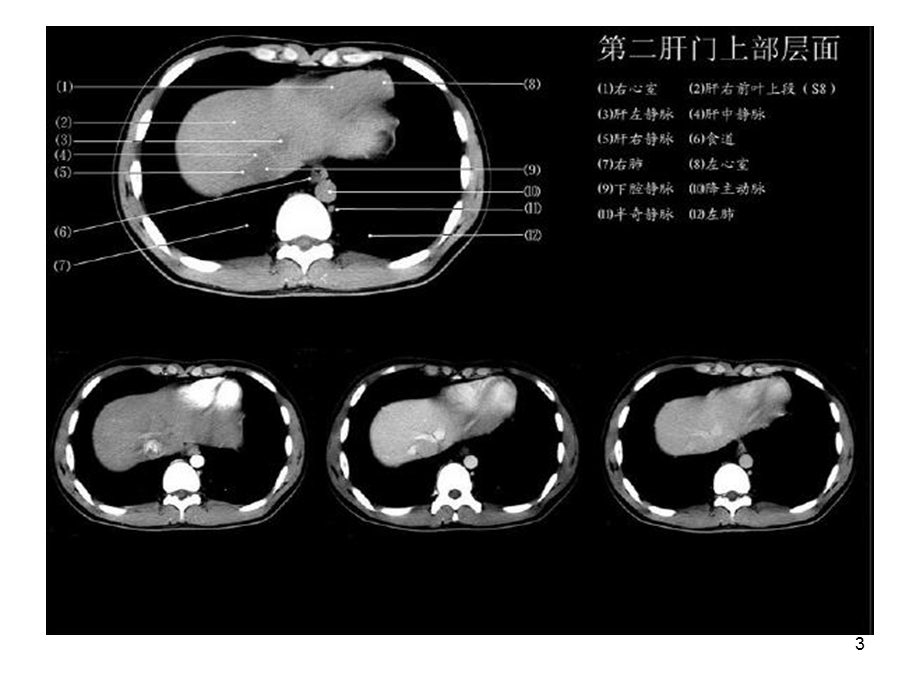 《正常肝脏CT解剖》演示PPT.ppt_第3页