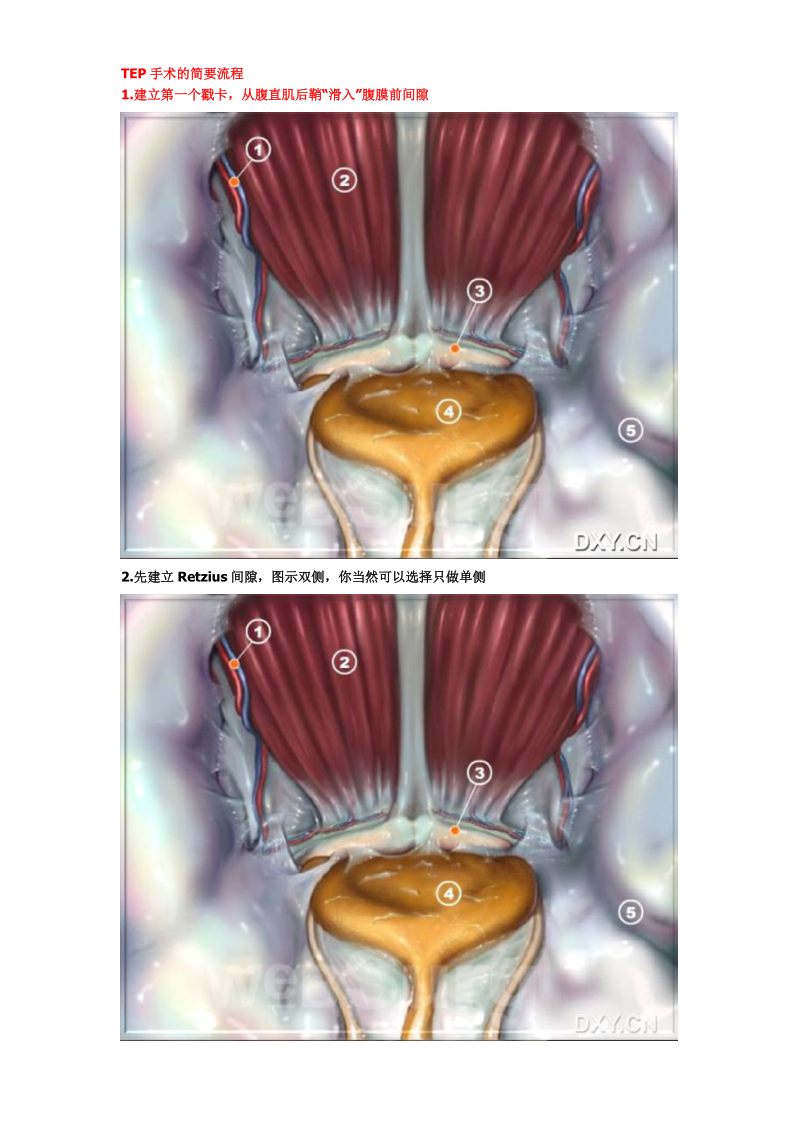 TEP手术的简要流程.doc_第1页