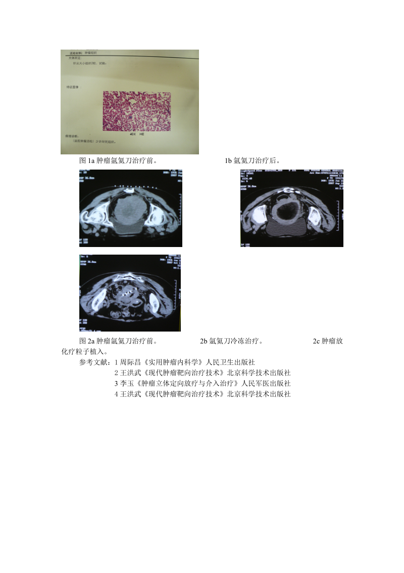 氩氦刀靶向冷冻结合放化疗粒子植入治疗老年盆腔巨大恶性肿瘤 罗凌飞.doc_第3页