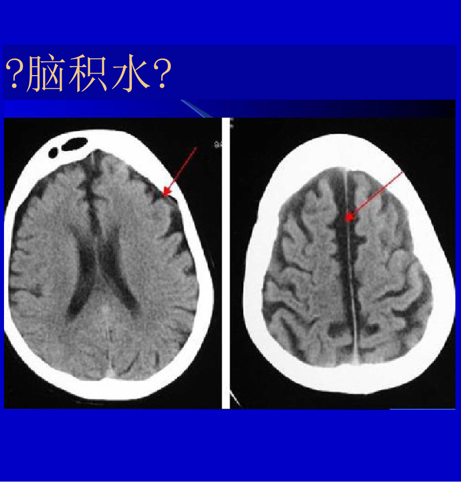 脑积水与脑萎缩的CT和MRI诊断.docx_第3页