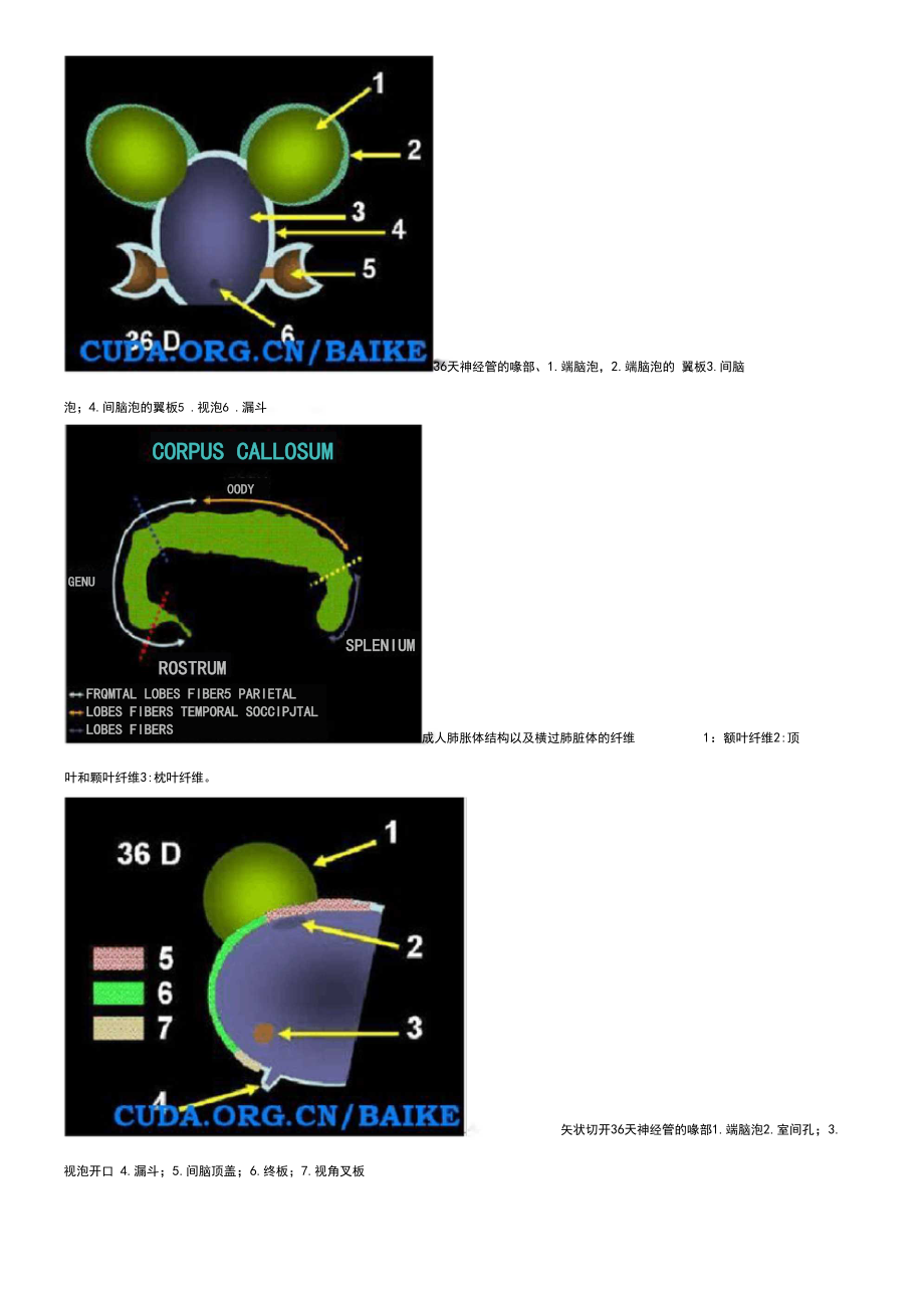 胼胝体发育不全或缺如.docx_第2页